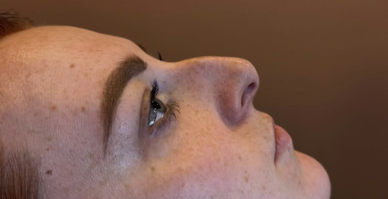 Nose before non-surgical rhinoplasty
